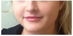 Juvederm Ultra Before & After Image