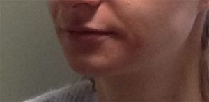 Juvederm Ultra Before & After Image