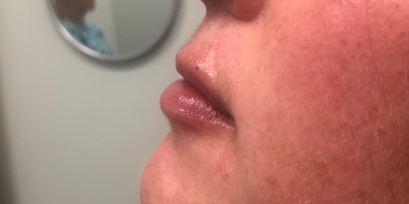 Juvederm Volbella Before & After Image