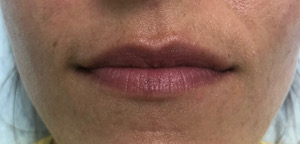 Juvederm Volbella Before & After Image