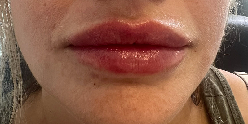 Lip Injections Before & After Image