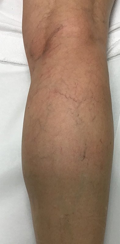 Spider-Vein Treatment Before & After Image
