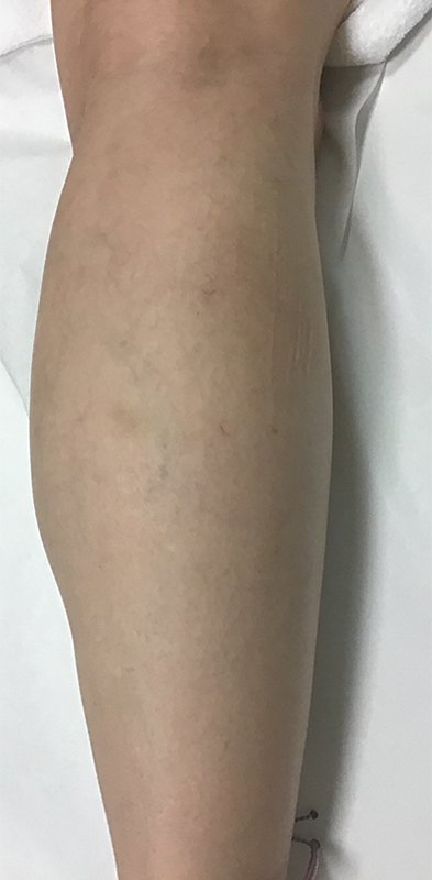 Spider-Vein Treatment Before & After Image
